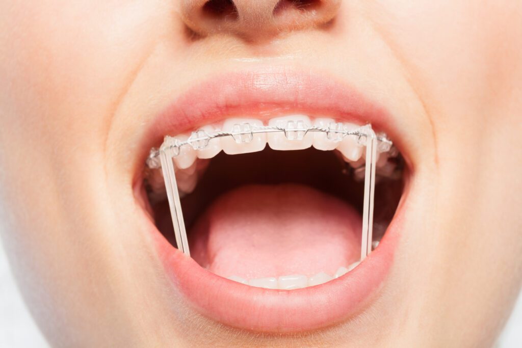 ceramic braces
