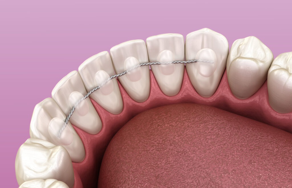 retainer Retention in Chelsea