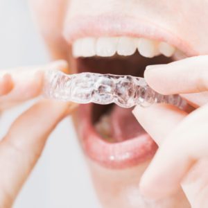 clear-aligners clear-aligners