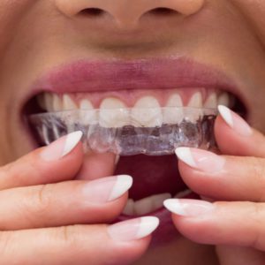 clear-aligners-chelsea clear-aligners-chelsea