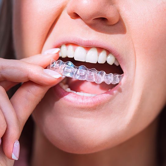 clear aligners in Taylor