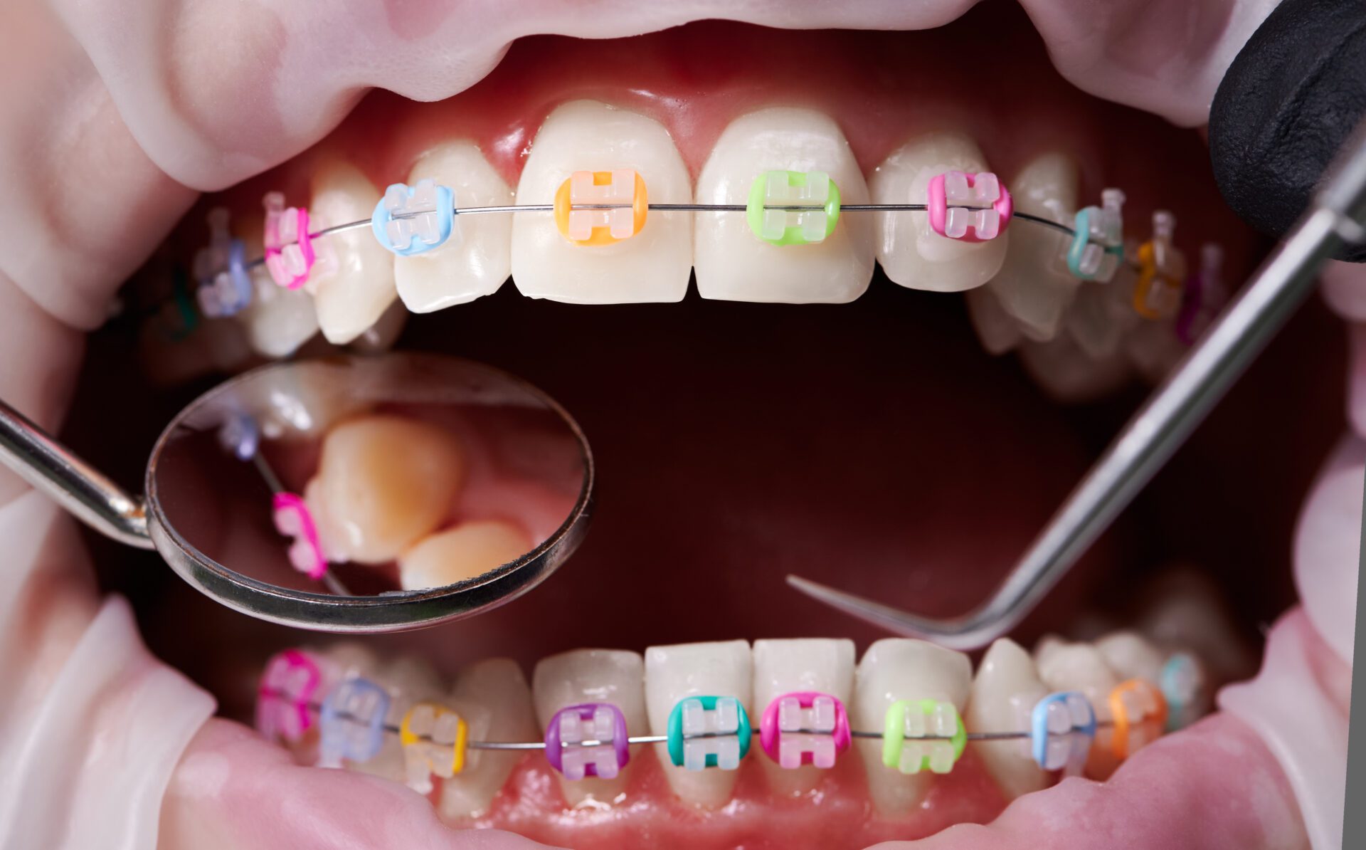 braces in Ann Arbor