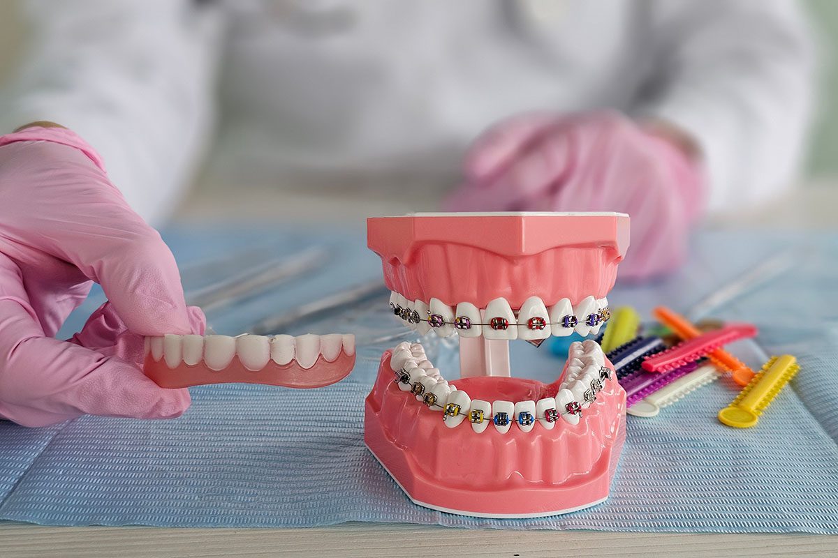 clear aligners in Dexter