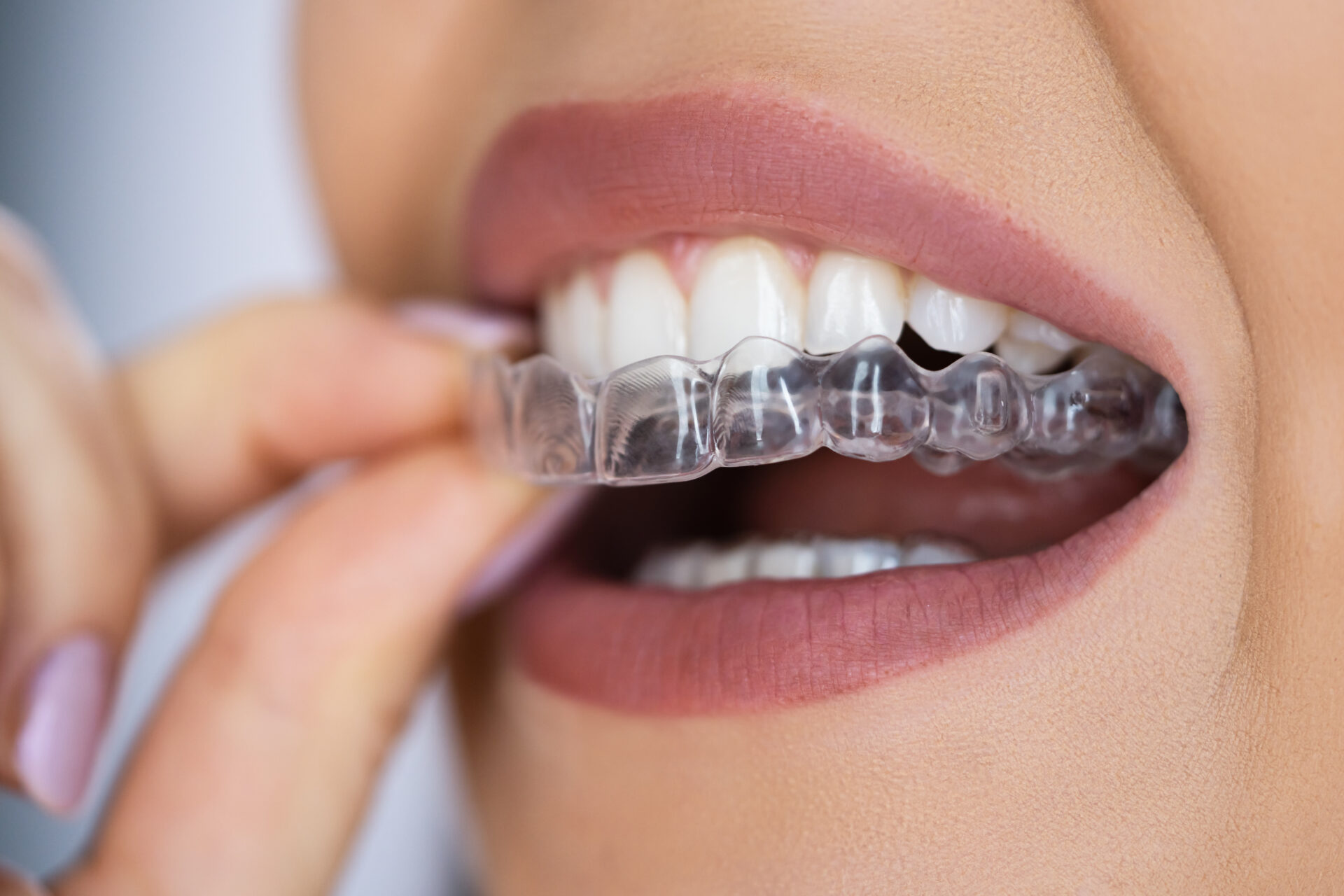 Invisalign in Plymouth orthodontist